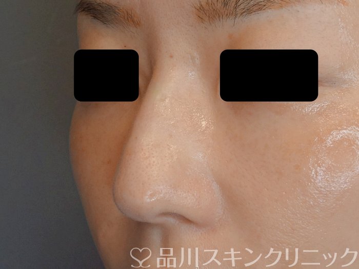 症例NO.71874のAFTER写真