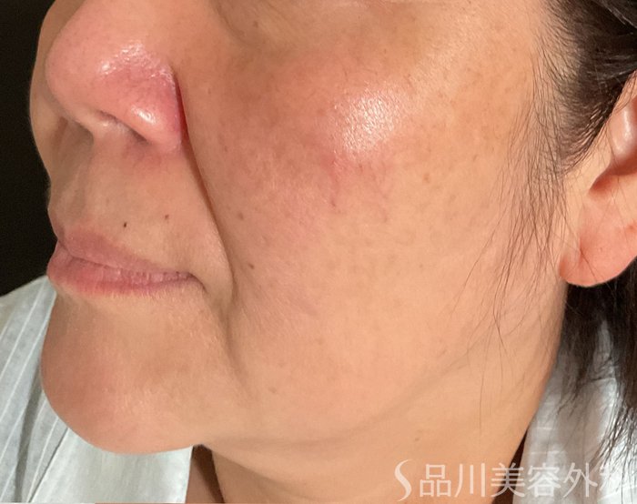 症例NO.75098のBEFORE写真