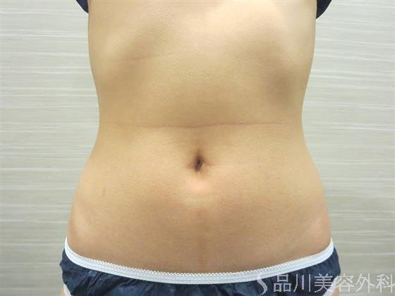 症例NO.21583のAFTER写真