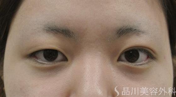 症例NO.16429のBEFORE写真