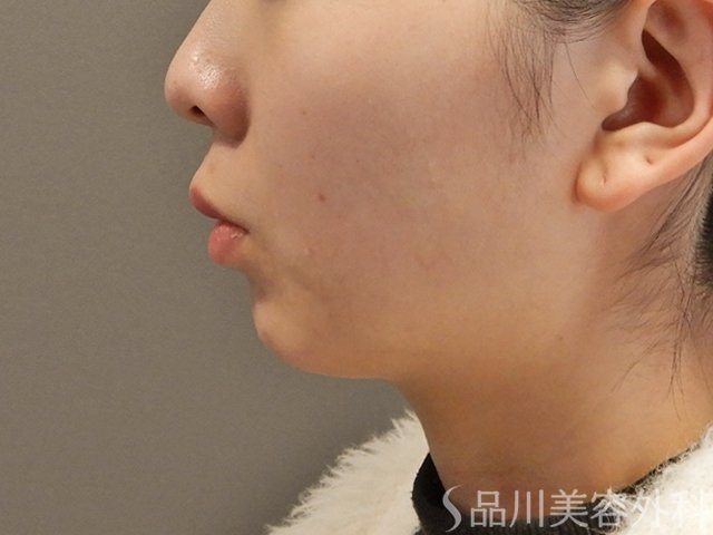 症例NO.73509のBEFORE写真