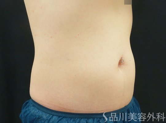 症例NO.70205のAFTER写真