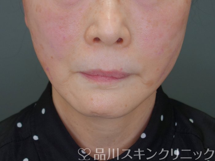 症例NO.72602のAFTER写真