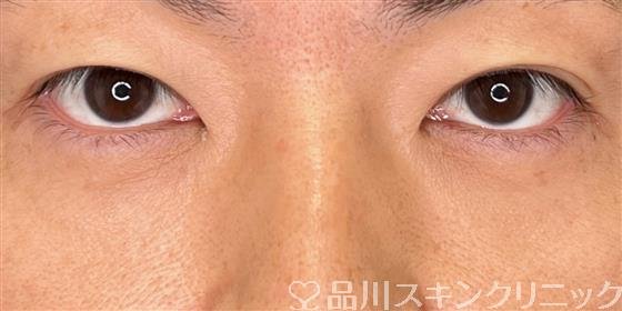 症例NO.55593のAFTER写真