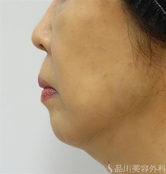 症例NO.37544のBEFORE写真