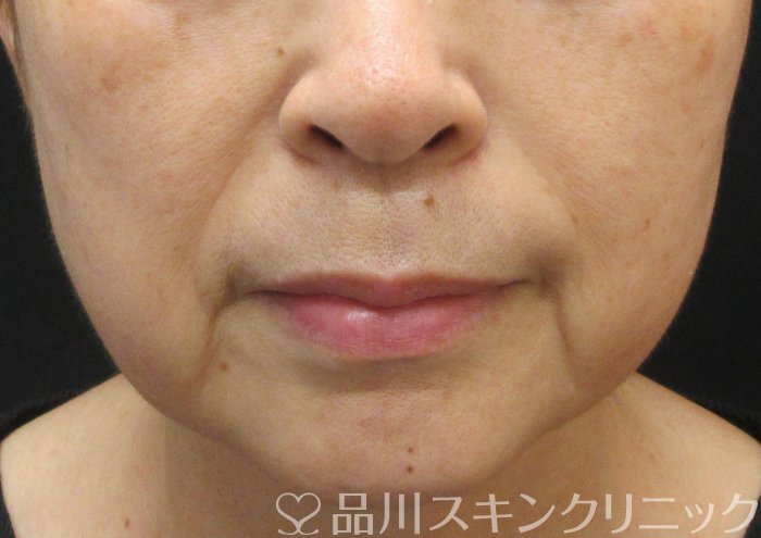 症例NO.73998のBEFORE写真