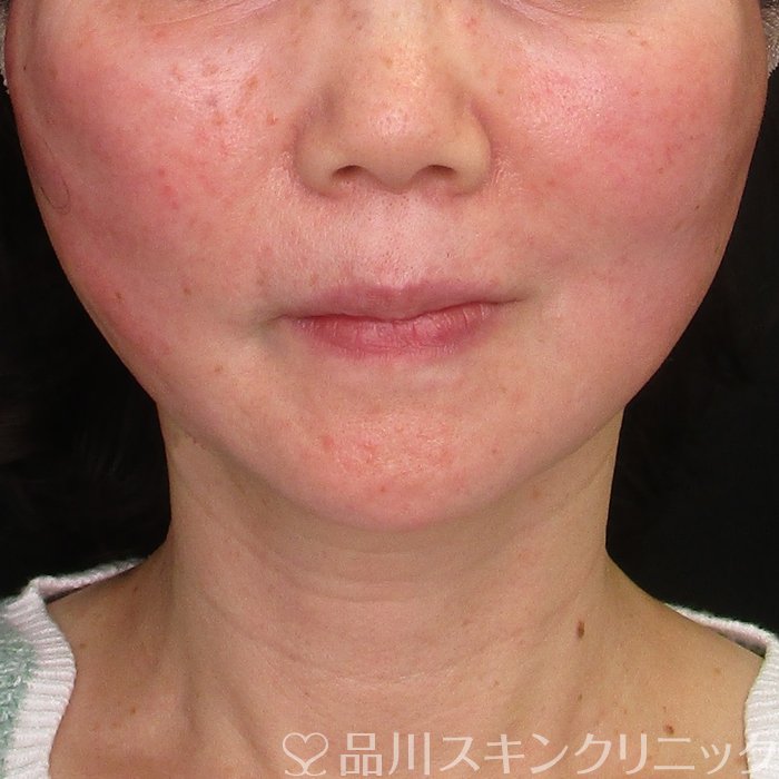 症例NO.70057のAFTER写真