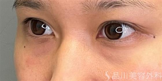 症例NO.51355のBEFORE写真