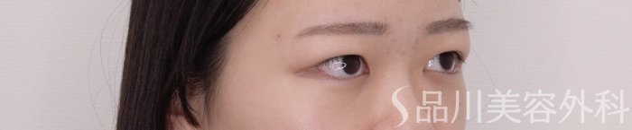 症例NO.69372のBEFORE写真
