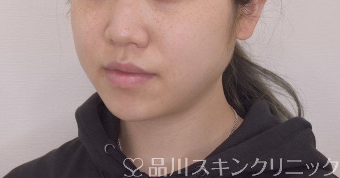 症例NO.64450のBEFORE写真
