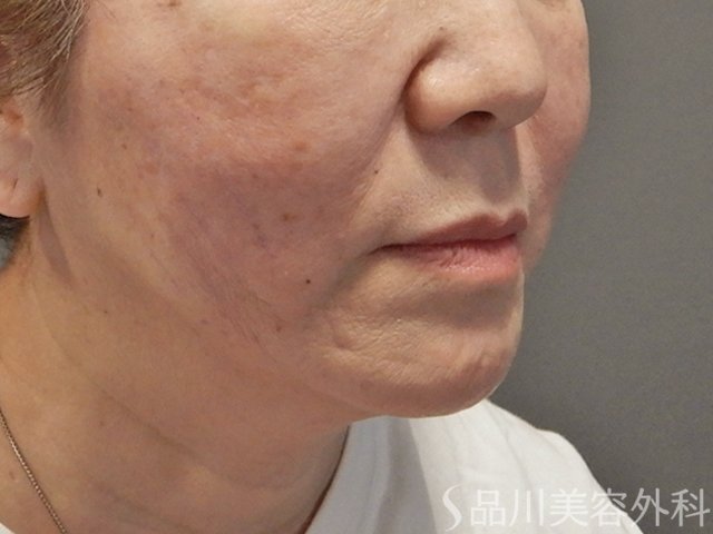 症例NO.73851のAFTER写真