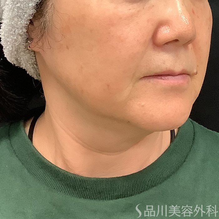 症例NO.75332のBEFORE写真
