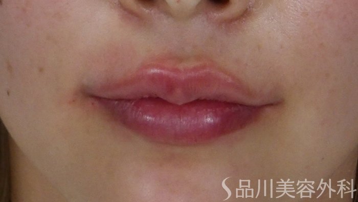 症例NO.70128のAFTER写真