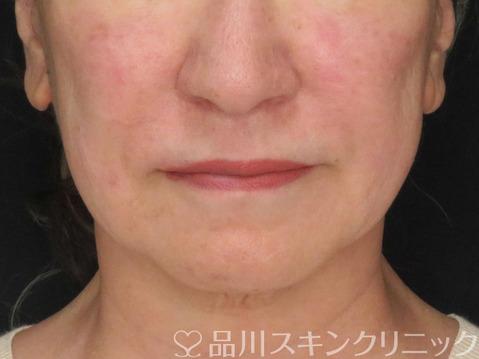 症例NO.67659のBEFORE写真