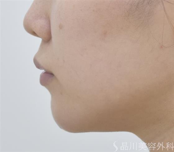 症例NO.44615のBEFORE写真
