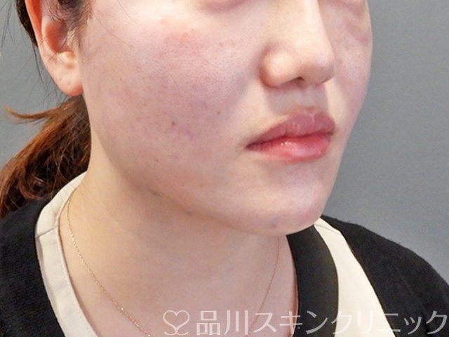 症例NO.67535のAFTER写真