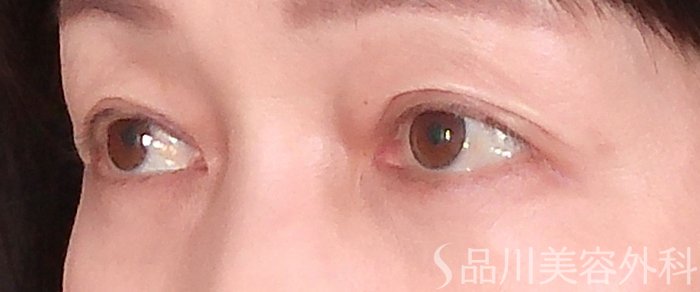 症例NO.69940のAFTER写真