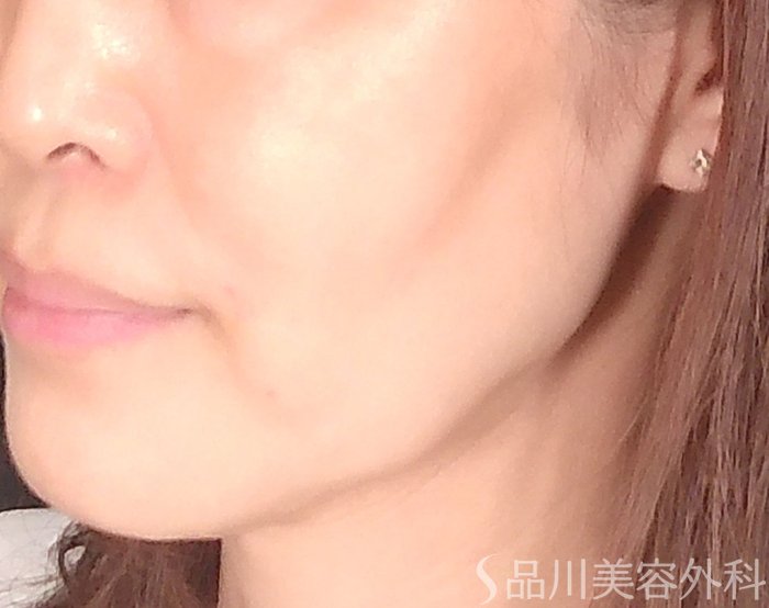 症例NO.70045のBEFORE写真