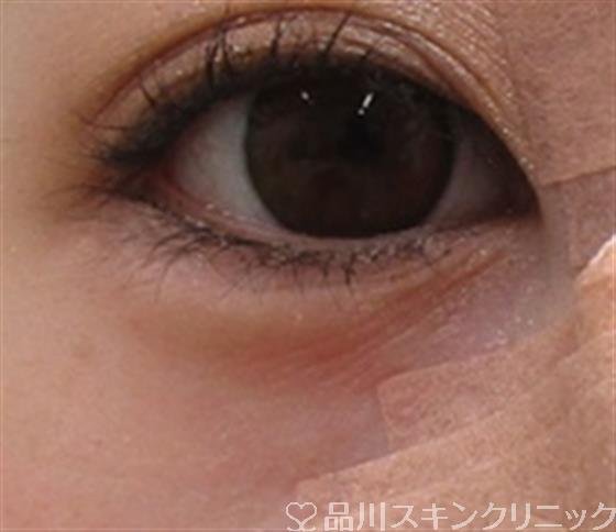 症例NO.38810のAFTER写真