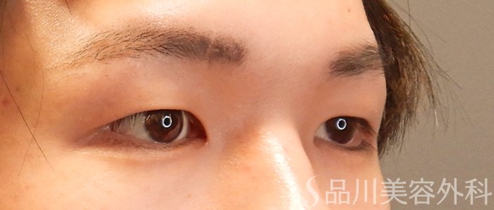 症例NO.70500のBEFORE写真