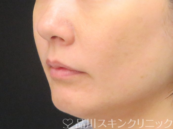 症例NO.70600のBEFORE写真