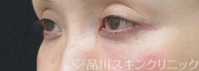 症例NO.74737のAFTER写真