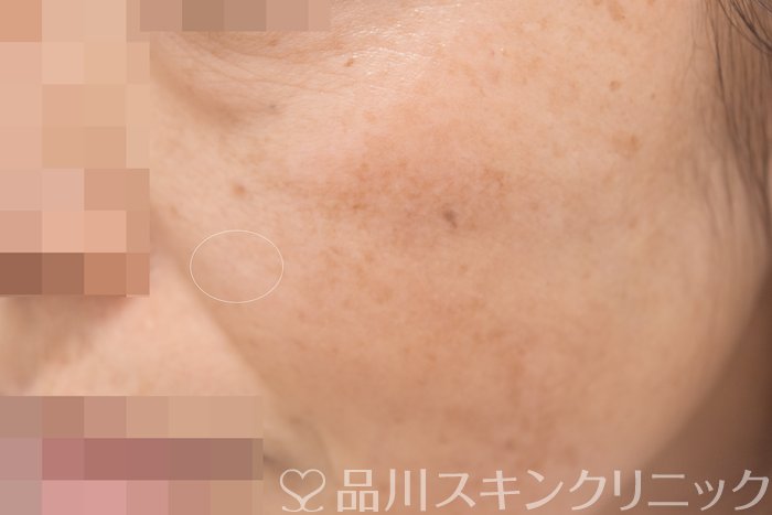 症例NO.64778のAFTER写真