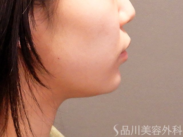 症例NO.69914のAFTER写真