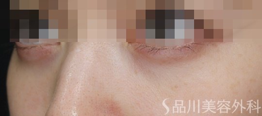 症例NO.70530のBEFORE写真