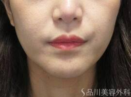 症例NO.71864のBEFORE写真