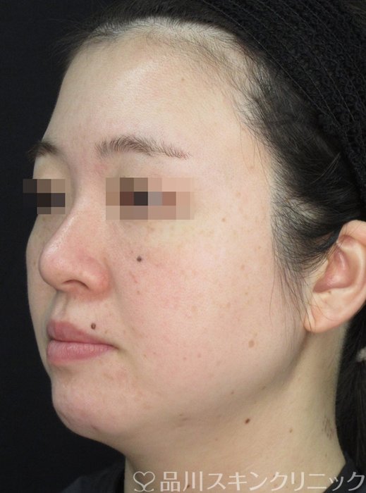 症例NO.72175のAFTER写真