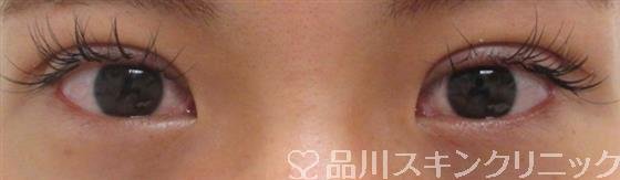 症例NO.25424のAFTER写真