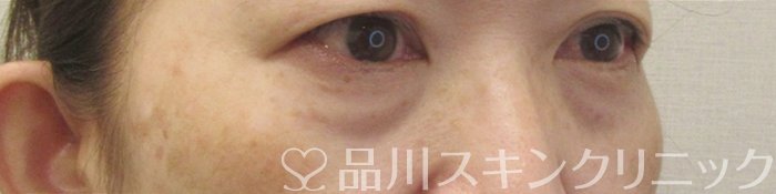 症例NO.71297のBEFORE写真