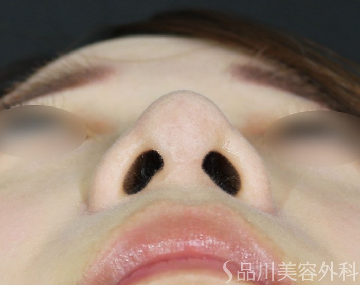 症例NO.65045のAFTER写真