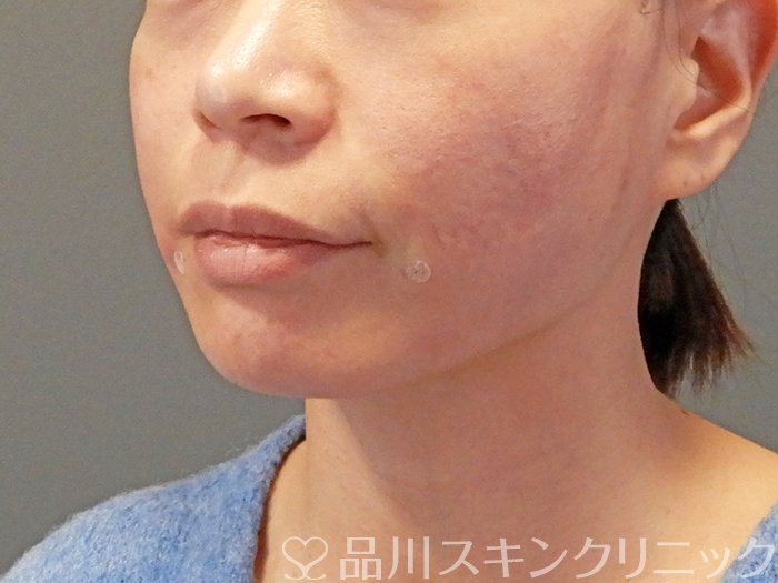 症例NO.63591のAFTER写真