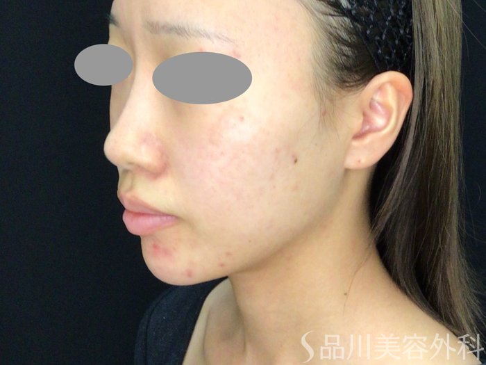 症例NO.71827のBEFORE写真