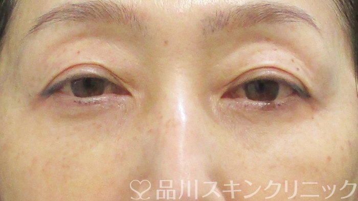 症例NO.74755のAFTER写真