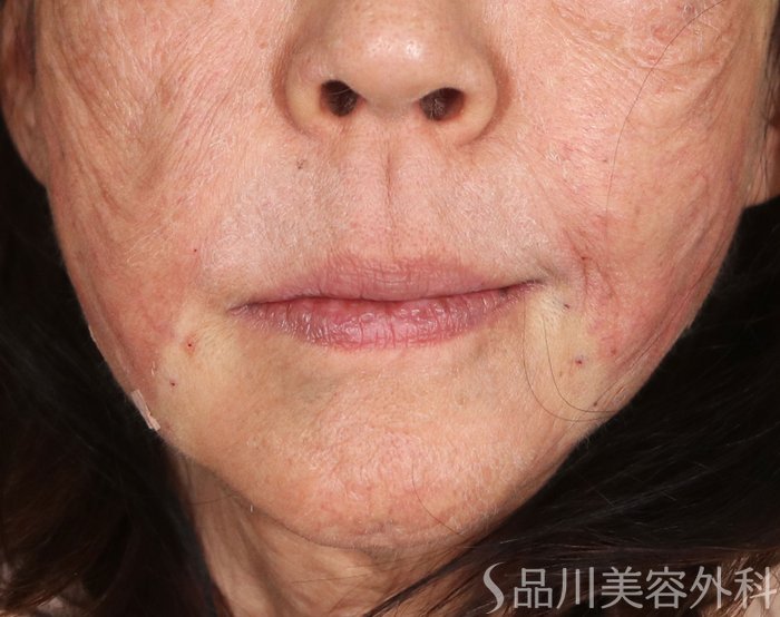 症例NO.73581のAFTER写真