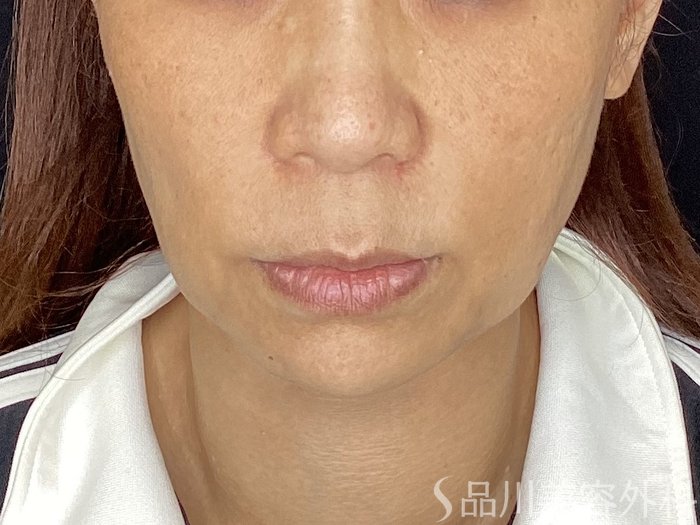 症例NO.67715のBEFORE写真