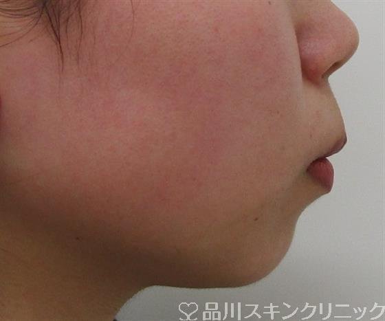 症例NO.40021のBEFORE写真