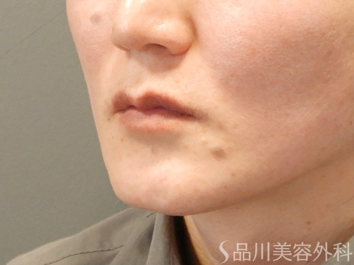 症例NO.70204のBEFORE写真