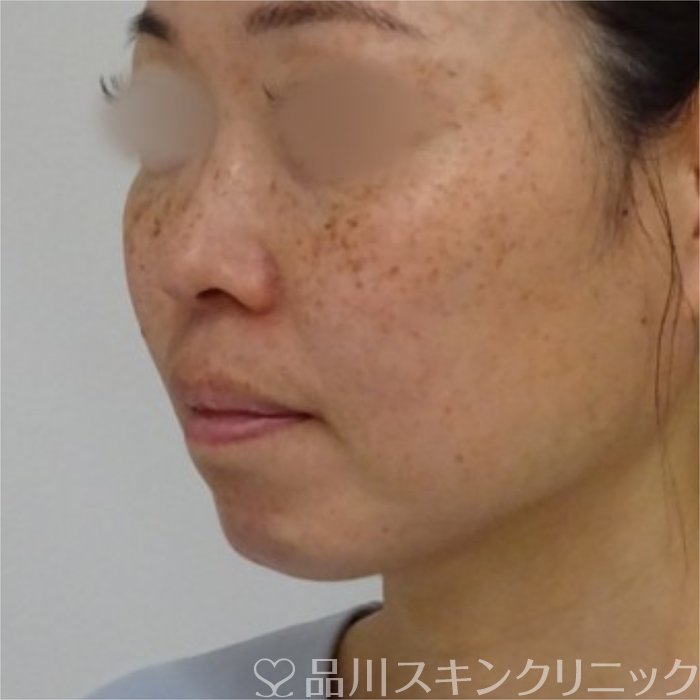 症例NO.70438のBEFORE写真
