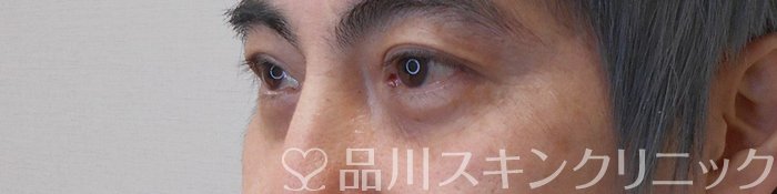 症例NO.70224のAFTER写真