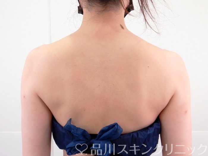 症例NO.62189のAFTER写真
