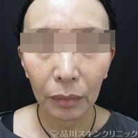 症例NO.71572のBEFORE写真