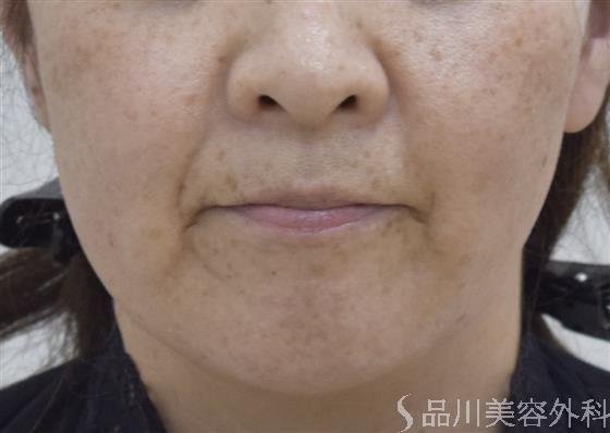 症例NO.48022のBEFORE写真