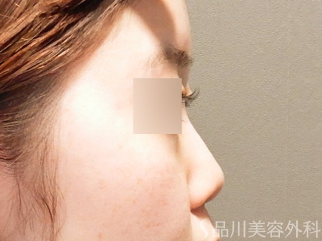 症例NO.69297のBEFORE写真