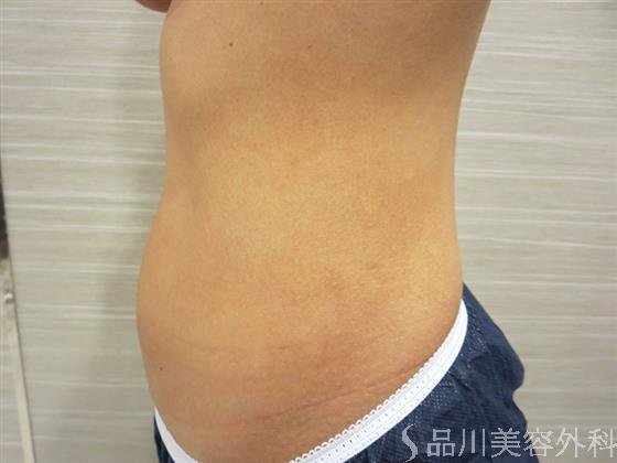 症例NO.20556のBEFORE写真