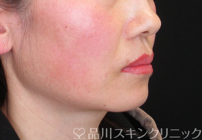 症例NO.75206のBEFORE写真