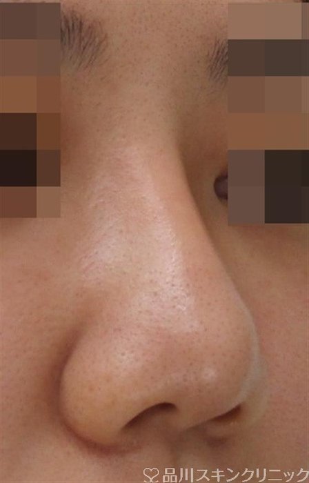 症例NO.38026のAFTER写真